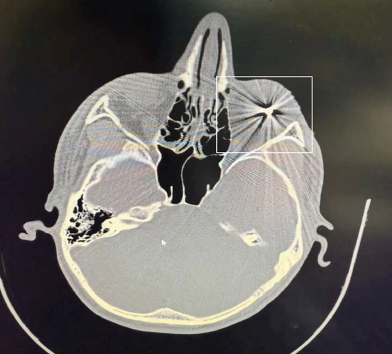 Obtained by Persian An exclusive CT-scan image obtained by Persian shows a metal pellet embedded in a Mashad protester's right eyeball.