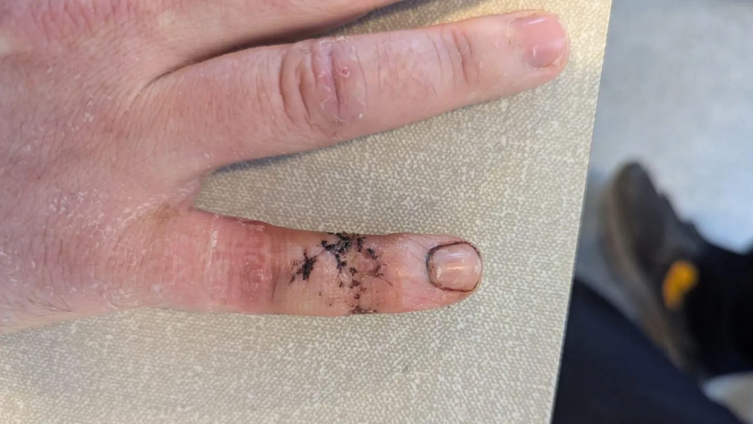 Stephen McKee A close up of Stephen's on the arm of a beige sofa. The little finger is swollen and has a number of black stitches in it. 