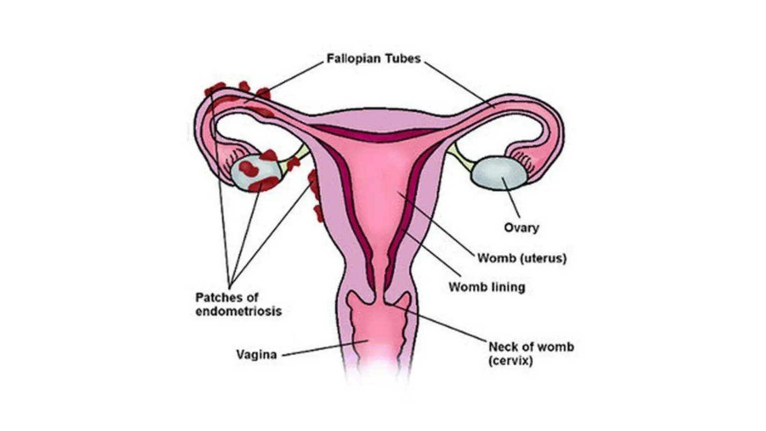 Endometriosis UK A diagram showing how endometriosis builds up around the fallopian tubes and ovaries.