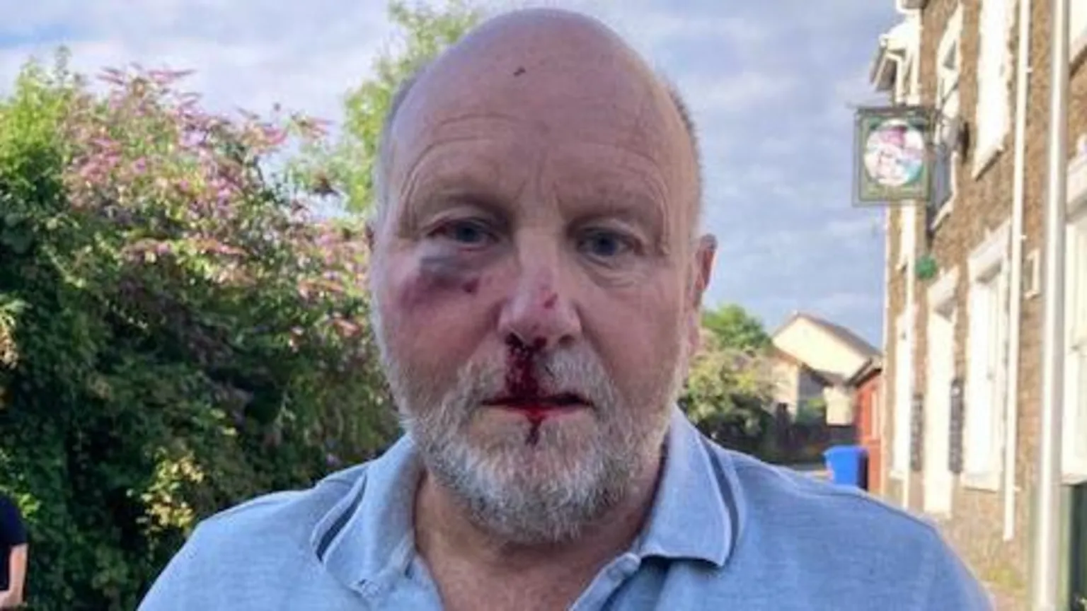 Christopher Lavis Christopher Lavis is pictures with blood streaming down his nose and a bruised. eye and looking shocked moments after the attack