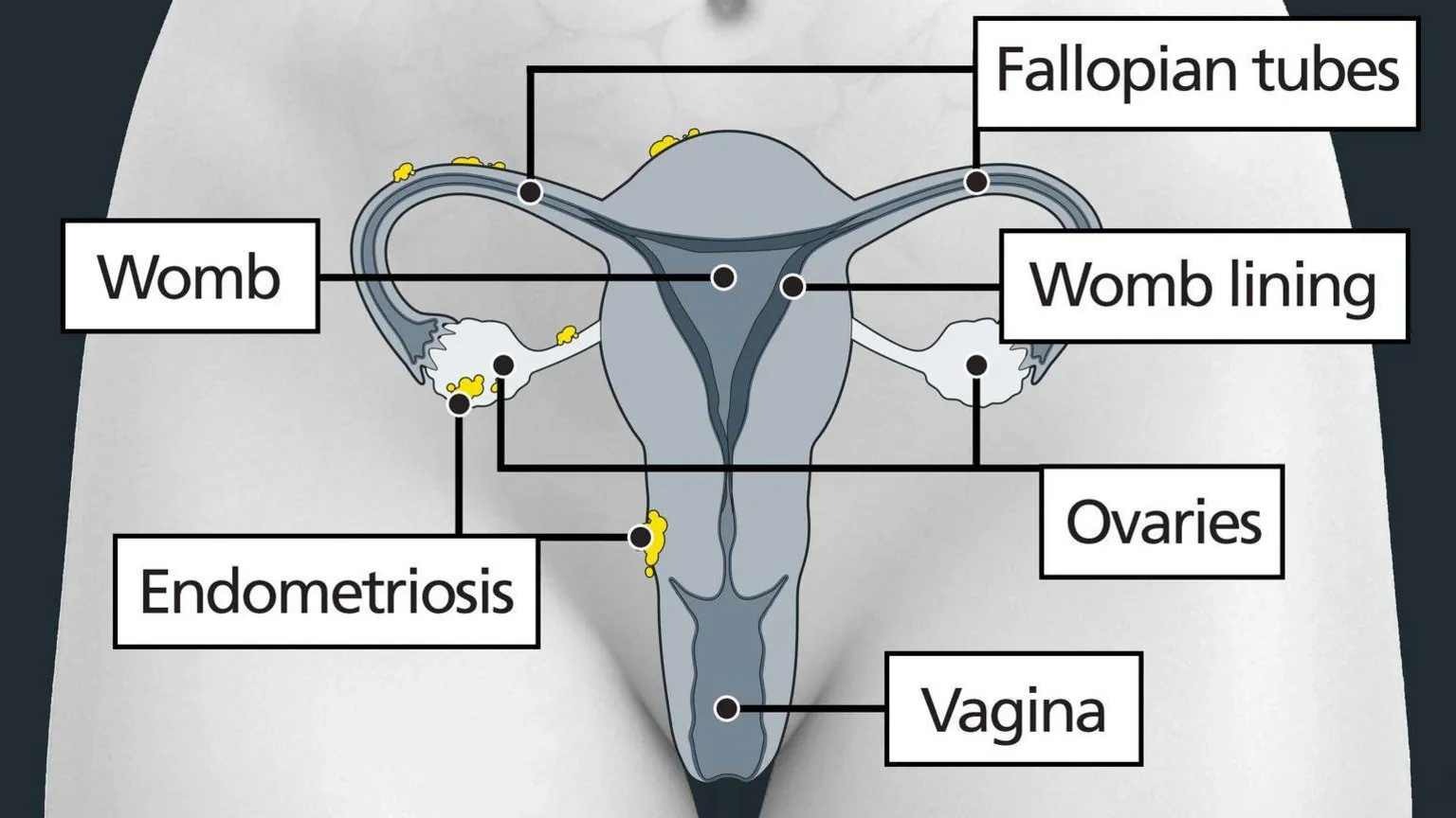 NHS The image shows a diagram of a woman's lower abdomen, with labels identifying the female anatomy. There are yellow clumps visible on the uterus, ovaries and fallopian tubes indicating endometrioma cysts.