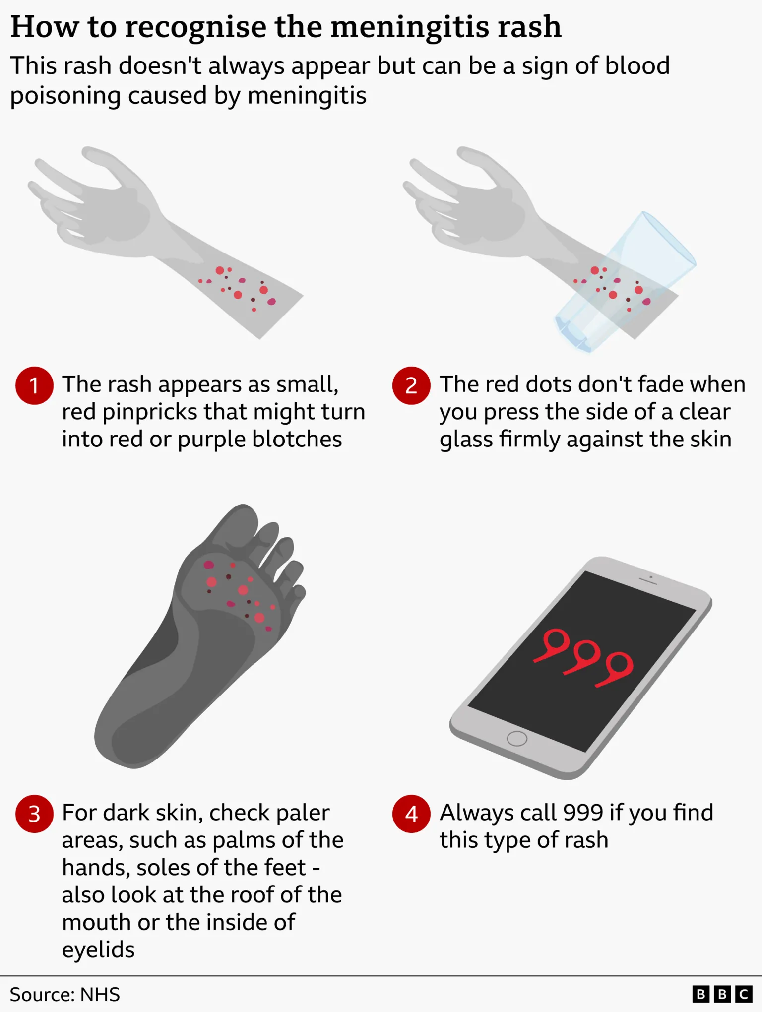 An infographic titled “How to recognise the meningitis rash.” It explains that the rash may signal blood poisoning caused by meningitis. The graphic shows an arm with small red pinprick spots. Step 1 notes that the rash appears as tiny red dots that may develop into red or purple blotches. Step 2 illustrates a clear glass being pressed against the rash, with text saying the spots do not fade under pressure. Step 3 shows a dark‑toned arm with highlighted areas, advising that on darker skin the rash is best checked on paler areas such as the palms, soles of the feet, the roof of the mouth, or inside the eyelids. Step 4 shows a phone displaying “999” and instructs to call emergency services immediately if this type of rash is present. Source: NHS
