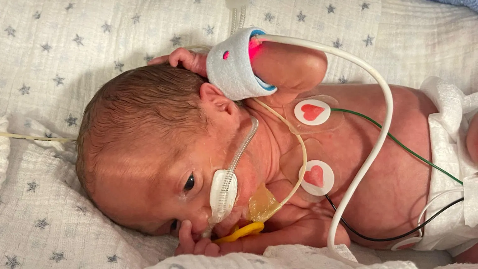 Laura Pridding A tiny baby lies on a bed, he has wires attached, with one going into his nose. He also has wires attached to his wrist and is sucking his thumb.