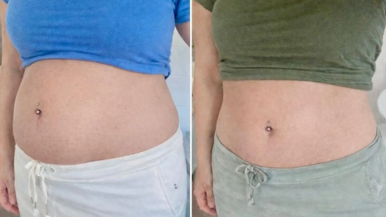 Nichola Howells This is two images of Nichola's abdomen edited side by side. To the left, Nichola has a very bloated stomach as a result of an endometriosis flare up. To the right shows Nichola's stomach on an average day which is considerably more flat.