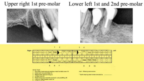 Mae'r heddlu'n gobeithio y gallai dannedd y dyn helpu i'w adnabod