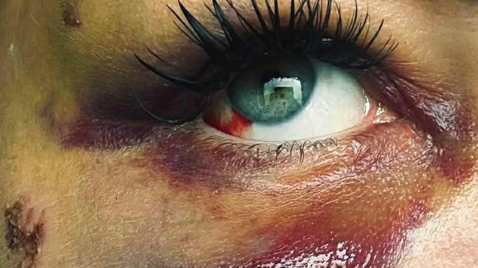 Anne Marie Boyle A close-up of a severely bruised and bloodshot eye, the skin all around it red and traumatised