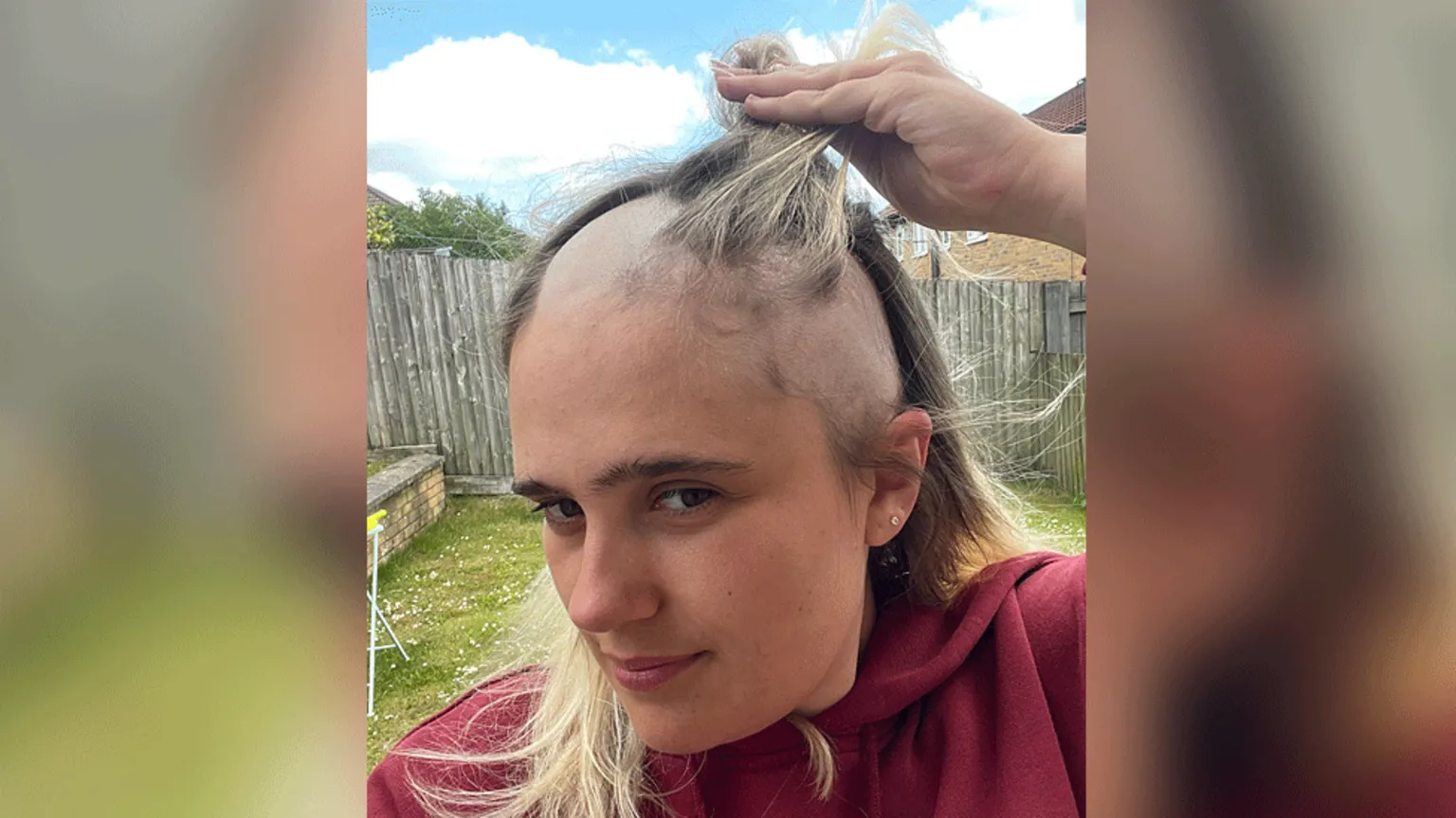 Phoebe Tesoriere Phoebe showing her hair loss whilst stood in a garden.