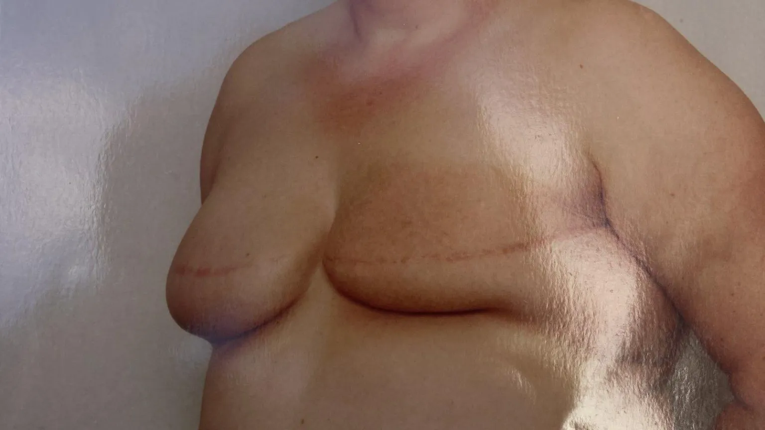 Handout A medical photo showing Marie Pinfield's breasts after her second mastectomy. There is still visible volume left in the breasts and there is a long red scar across them.