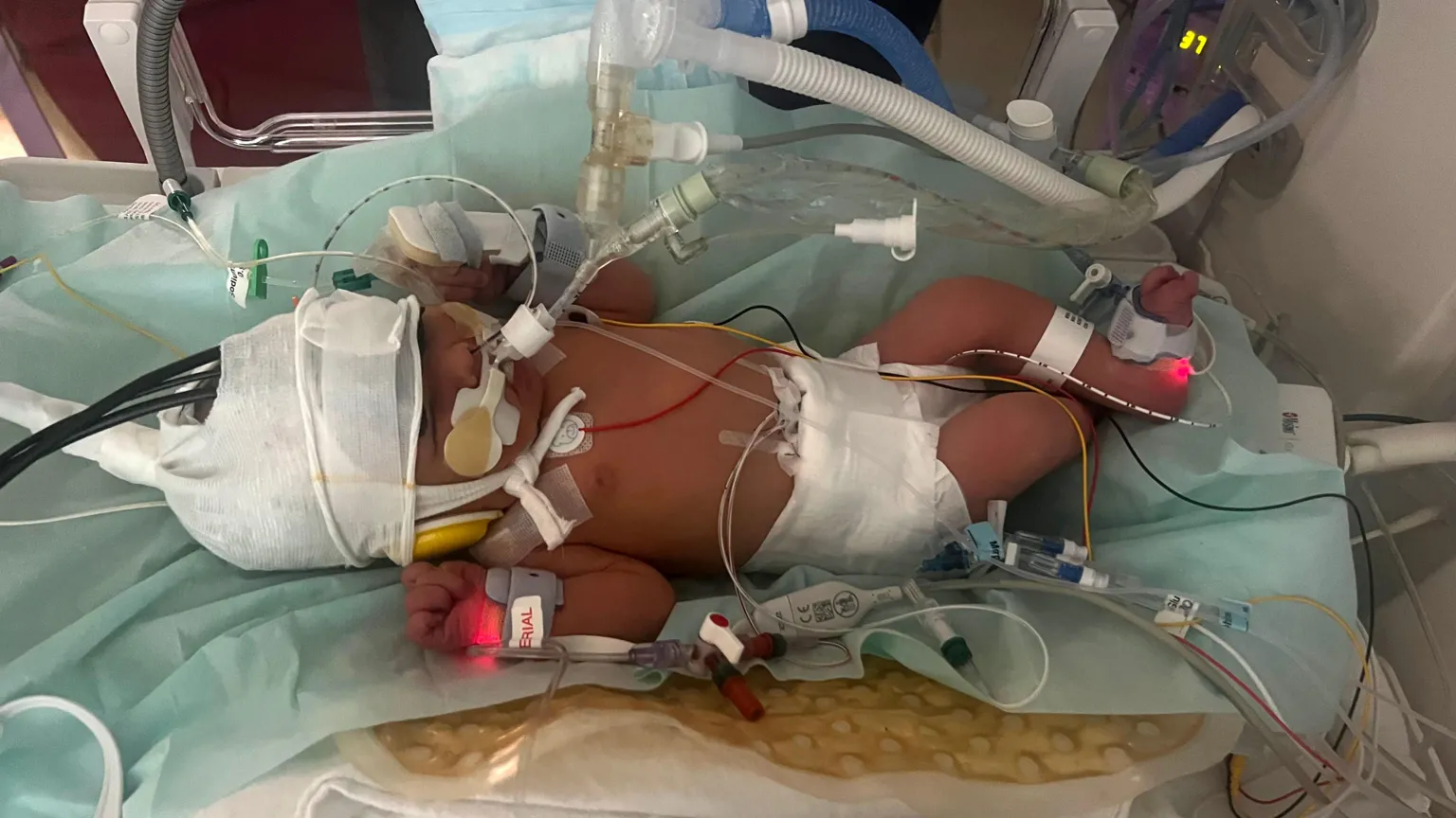  A newborn child in a hospital cot with medial equipment on her body.