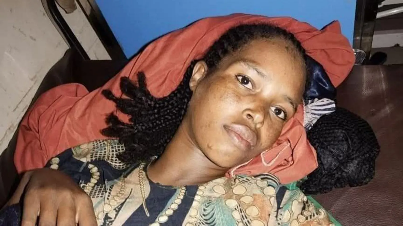 Hiwot Fana Specialised Hospital Close-up of Bedriya lying down. She is wearing a printed green and black top and is resting her head on a red blanket