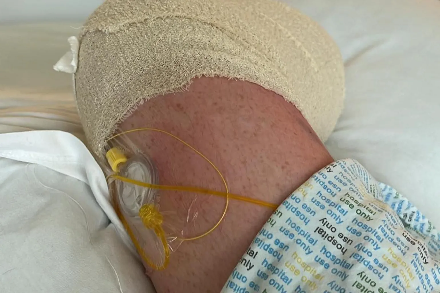 Jayme Stephen A woman's amputated leg on a hospital bed with a bandage on