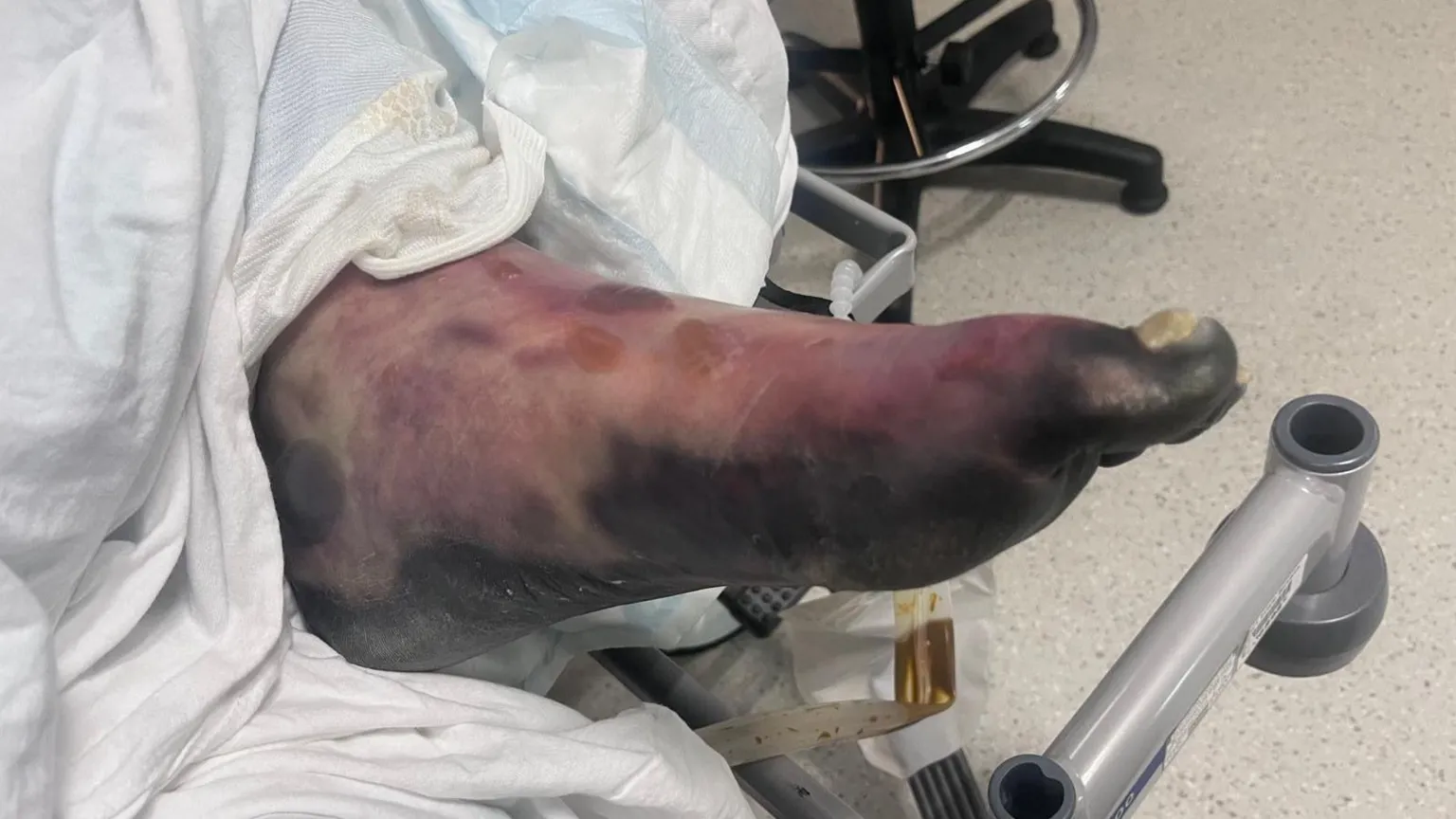 Marshall Wylie A foot hangs from white bed sheets, discoloured and swollen. The sole and big toe are black, then the colour changes to purple and blue as it moves towards the ankle. 