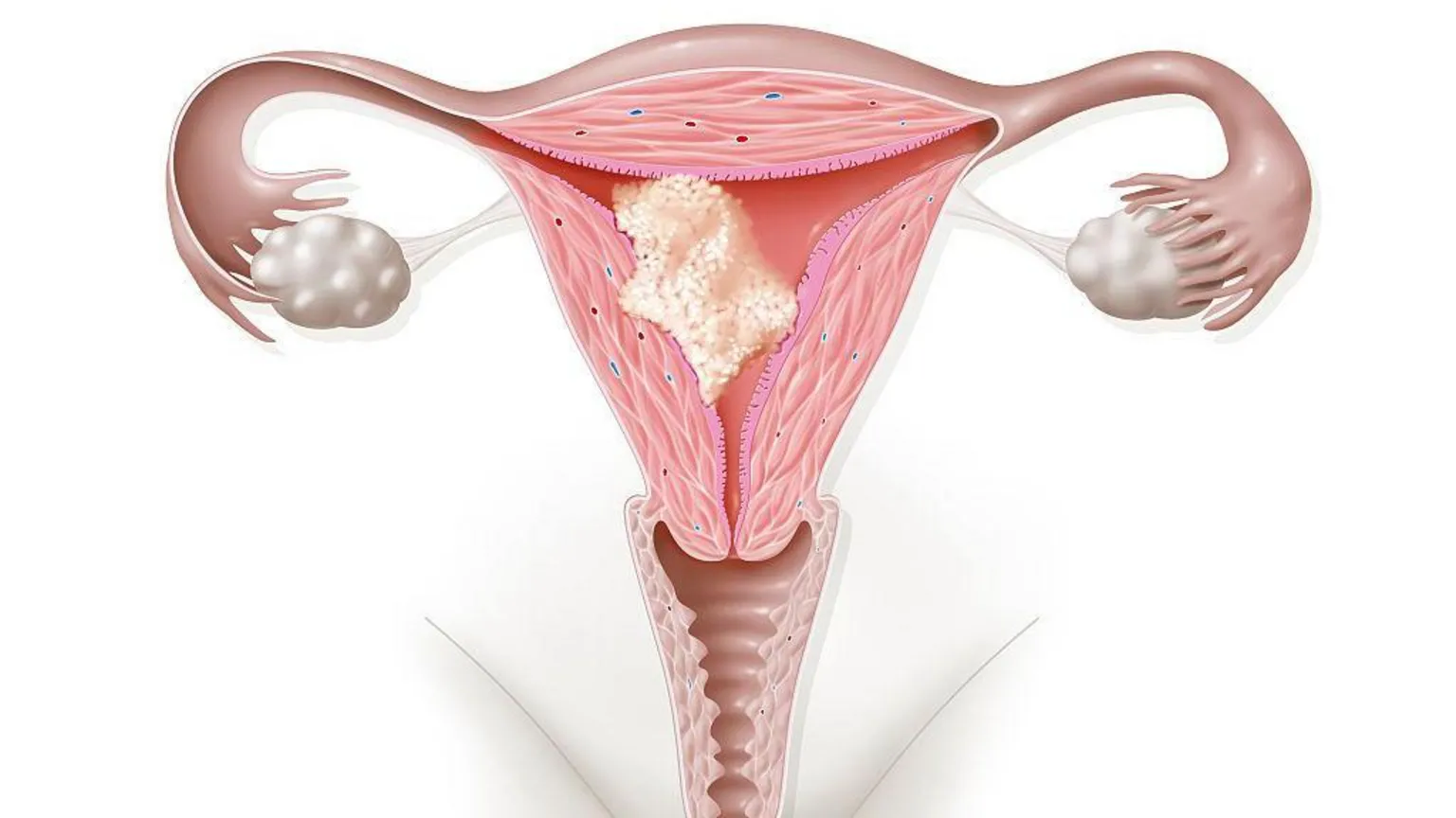 An illustration of a womb with a cancer tumour growing within it.