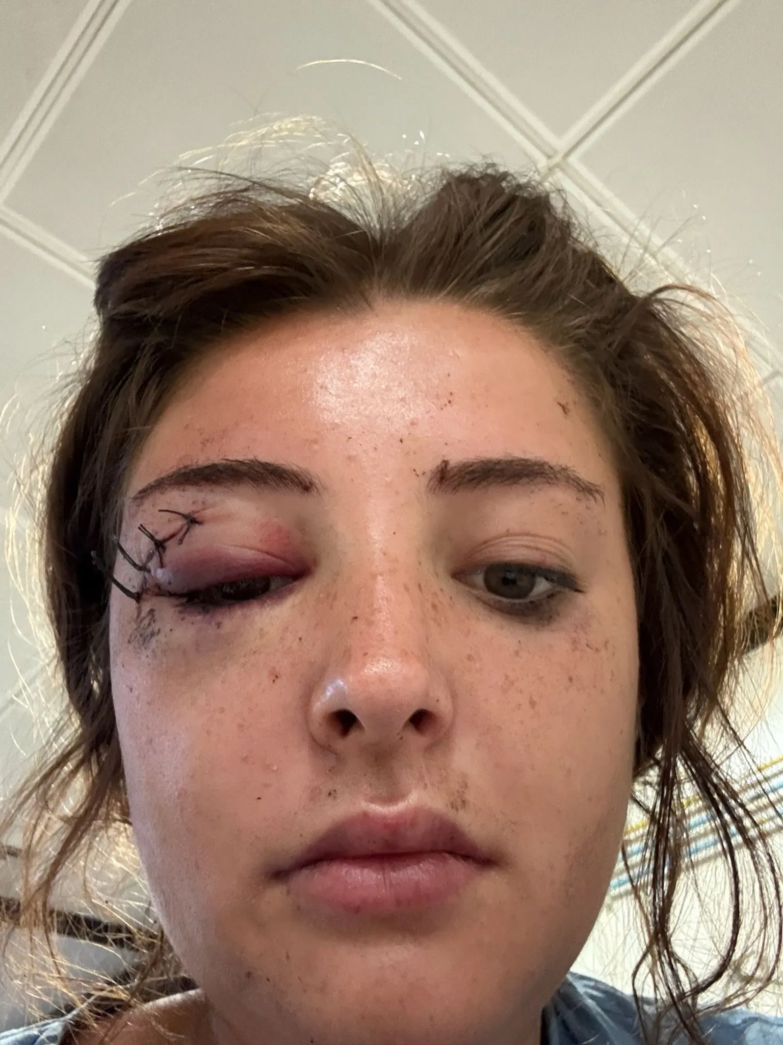 Nic North A girl with stitching on her eye smiles