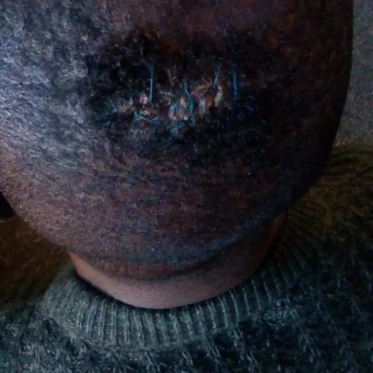 Wound with stitches on top of a man's head