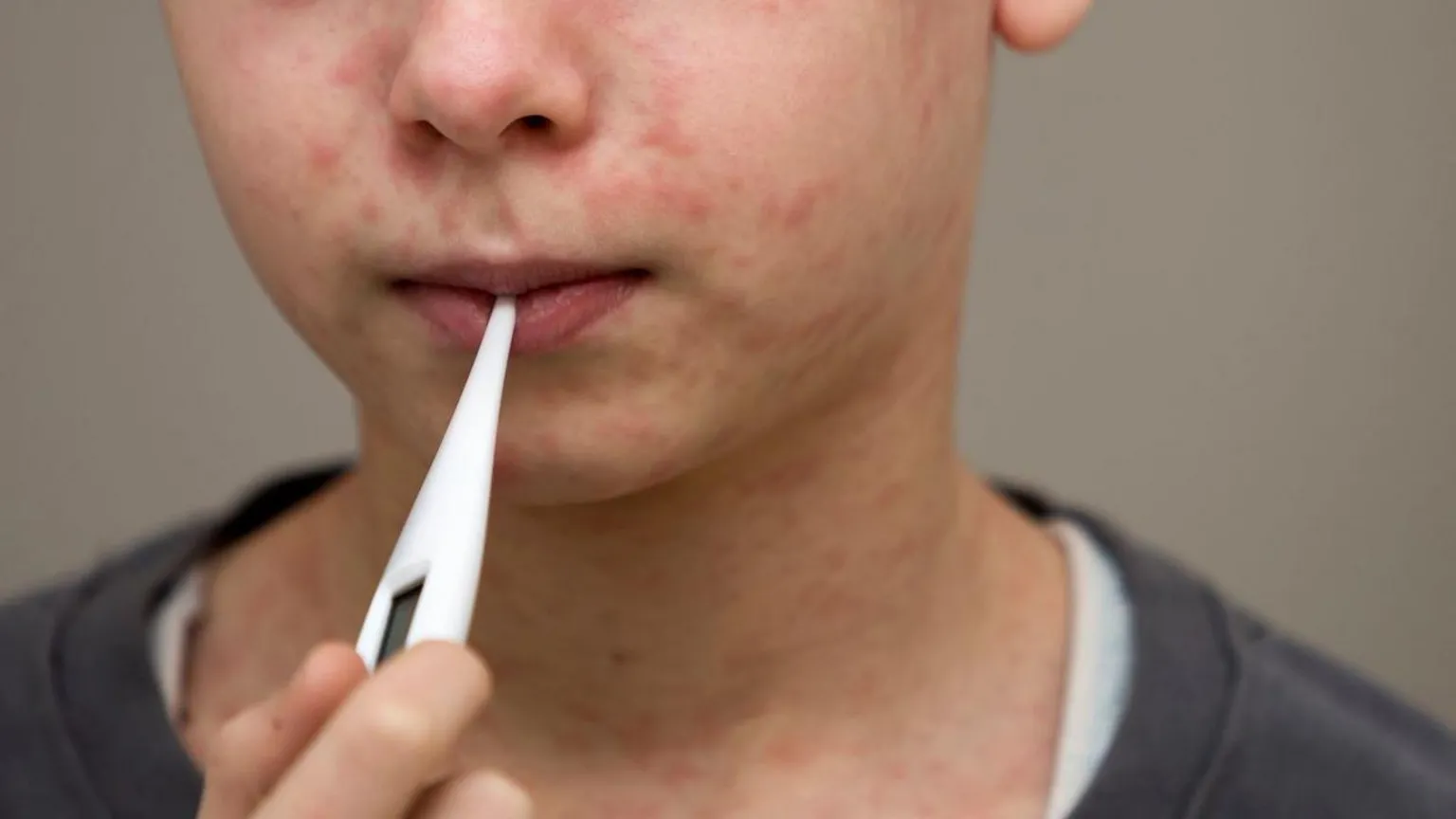  Child with rash has temperature taken with thermometer