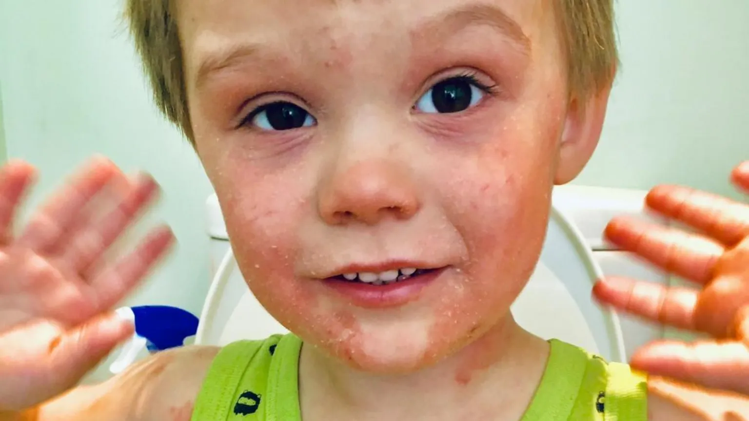 Katie Hutt A young Yann Jennings wearing a green vest covered in hives from his allergies.