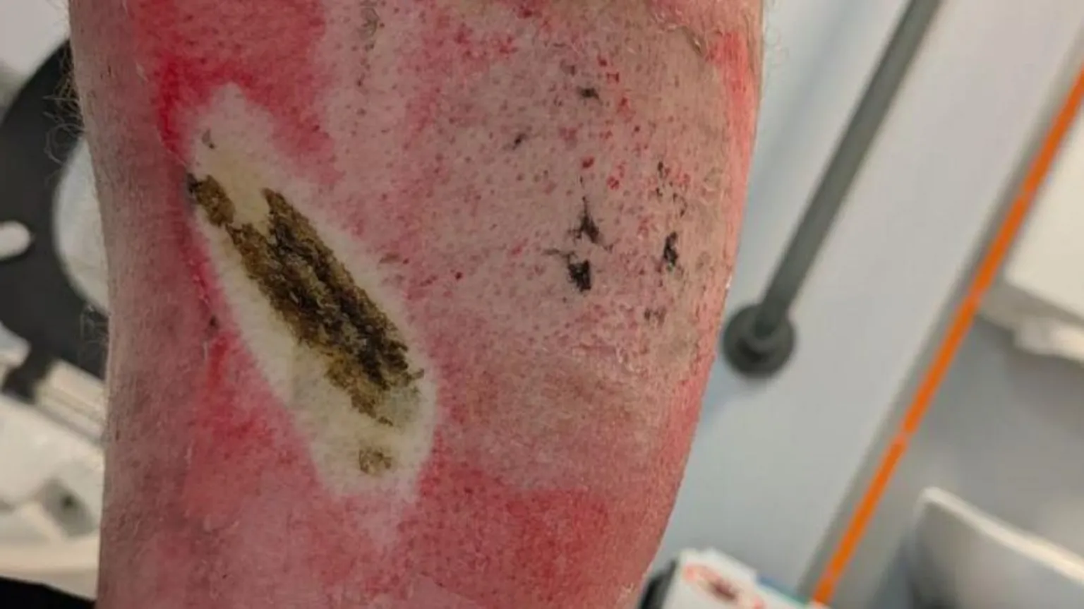 SCAA An image showing serious burn injuries to a man's leg.