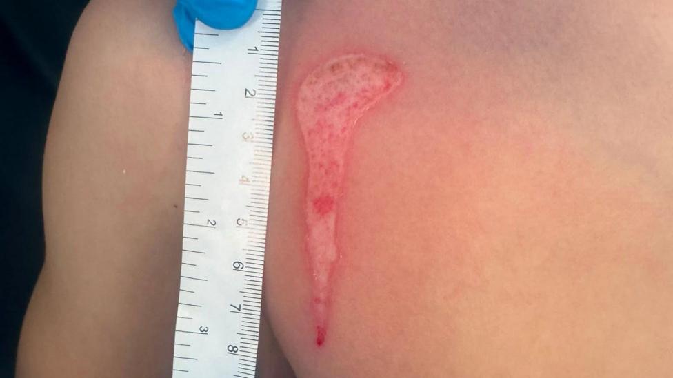 A close-up of a young boy's chest, with burn marks on it. 