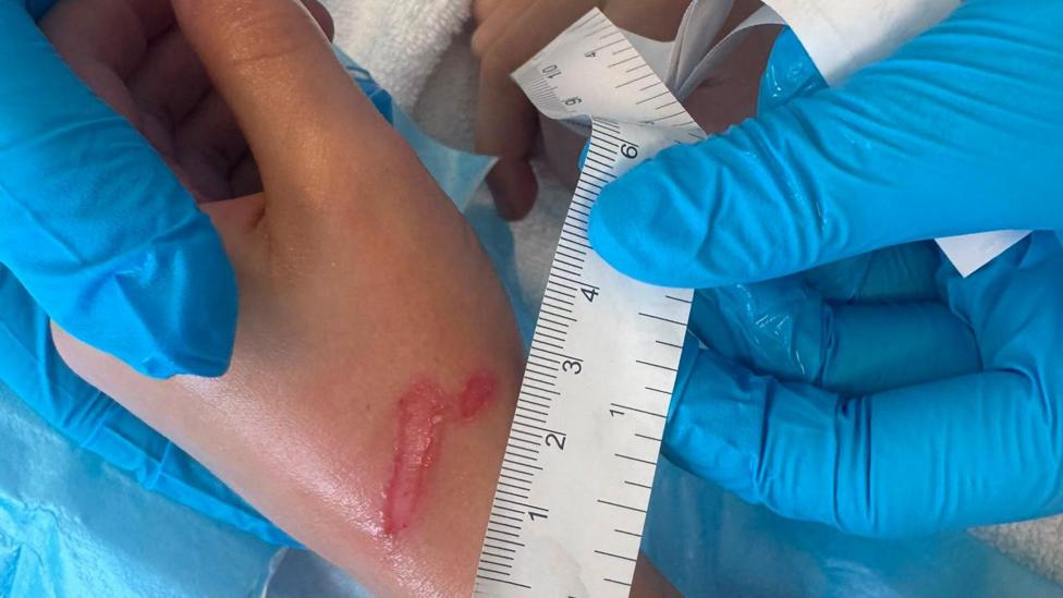 A close-up of a boy's burned hand, being held by medical professionals who have measuring tape next to it to show how badly it was affected. 
