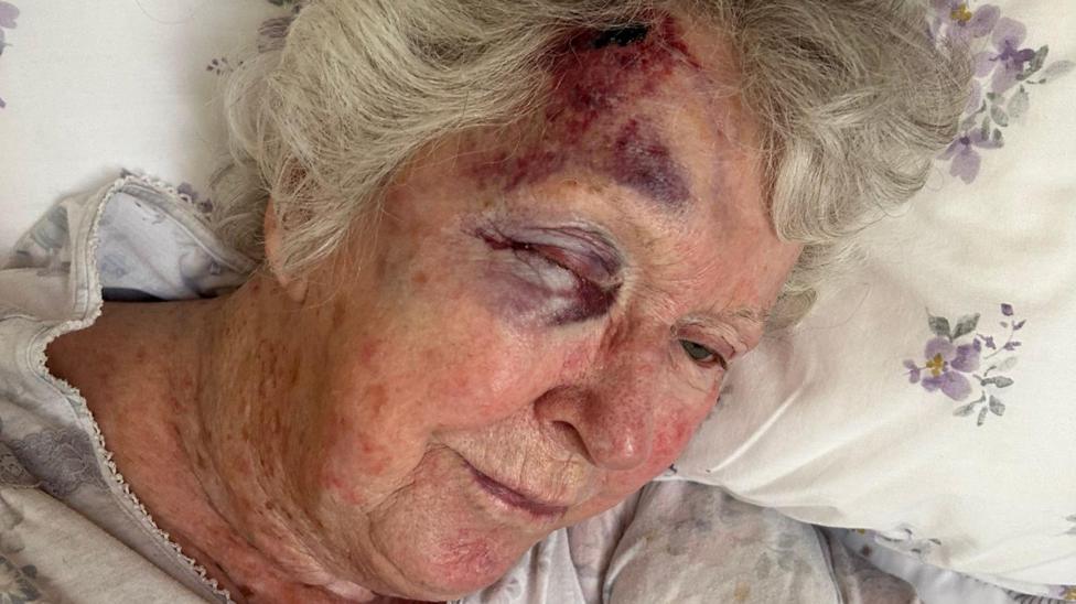A photo of an elderly lady with her face close up bruised and her eye is quite swollen. She is in bed with leaning her head against the pillow with purple flowers on it. She is wearing her night dress and has white hair. 