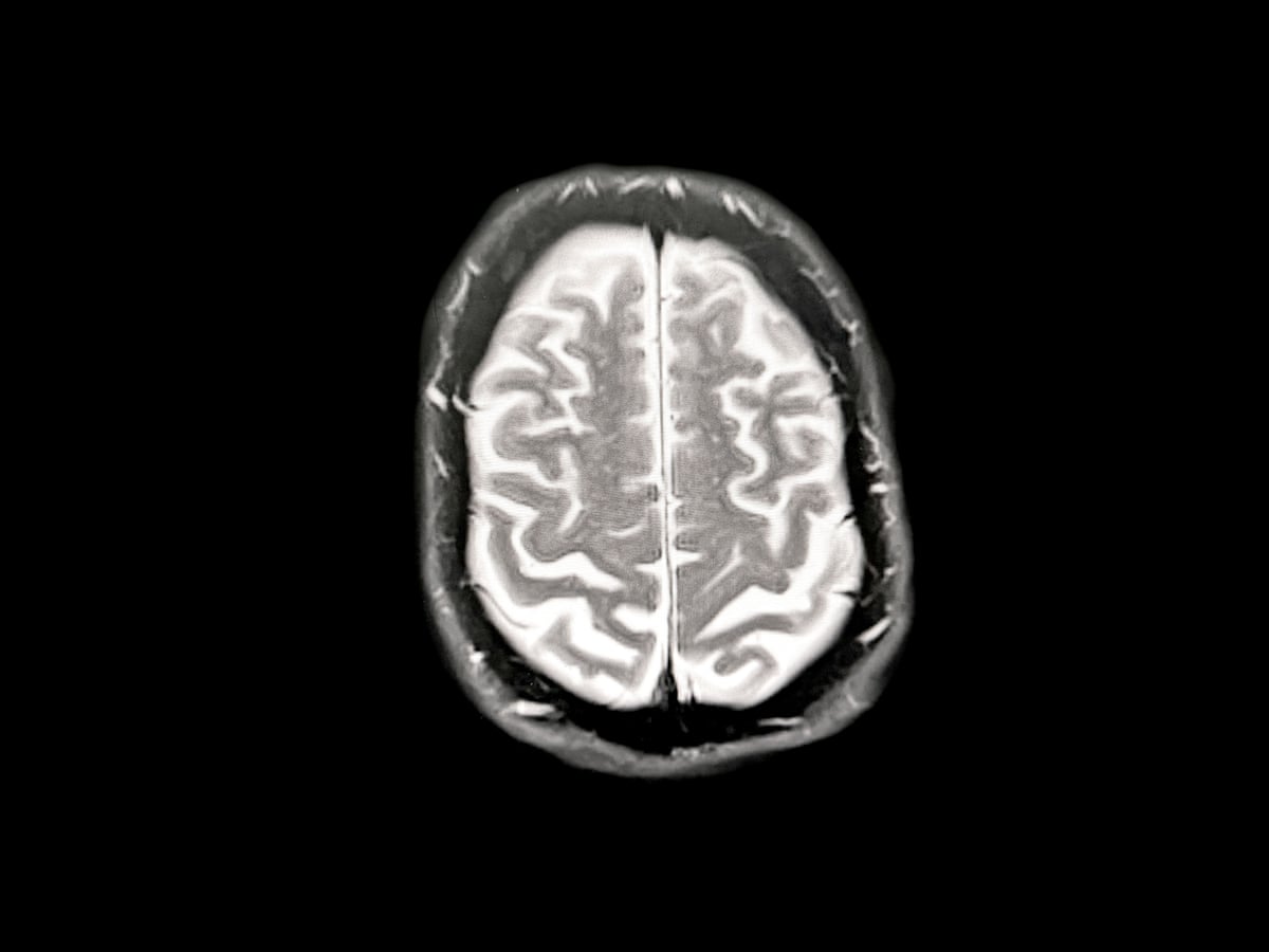 Scan of brain