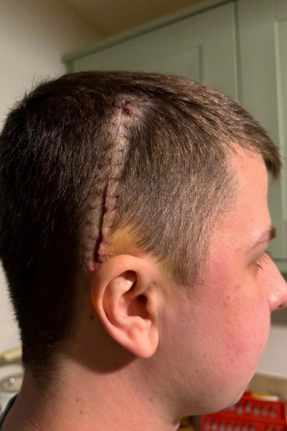 The side of Joshn's head. There is a parting in his hair where a long red stitched-up wound and bruising is visible.