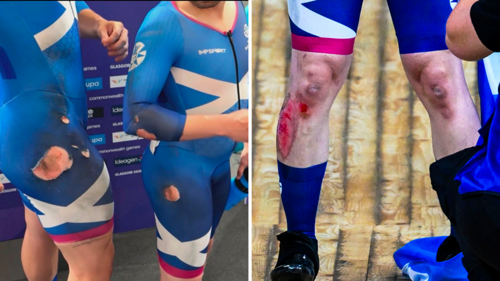 Neil Fachie shows his injuries