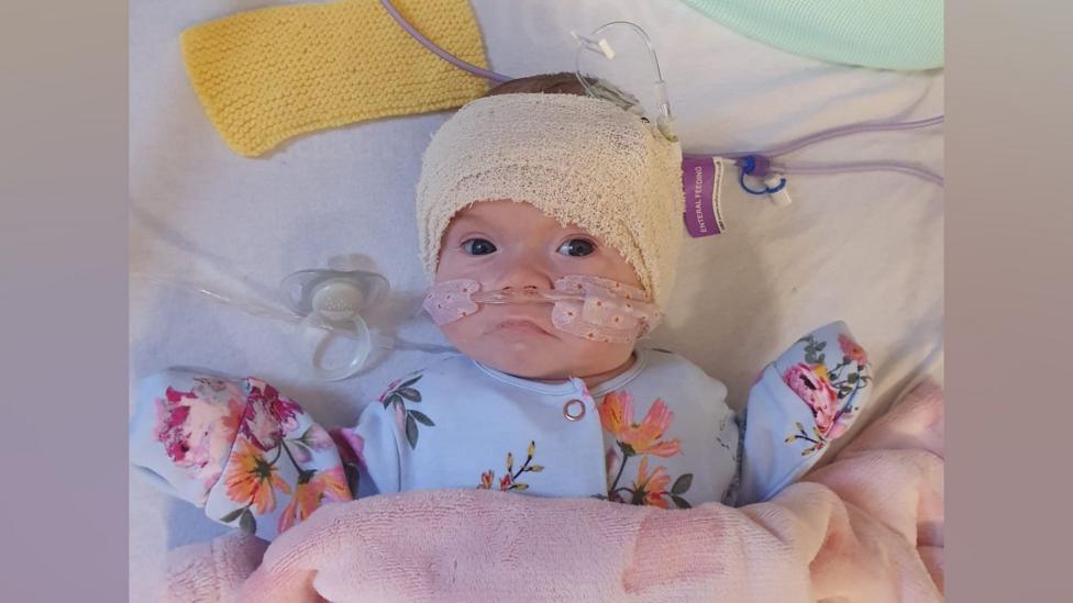 A young baby, Lila with bandages on her head and a tube through both nostrils. She has her arms out to the side of her body, at shoulder height and is wearing a blue floral baby grow. A soother can be seen near her right shoulder. She is lying on a bed with white sheets.