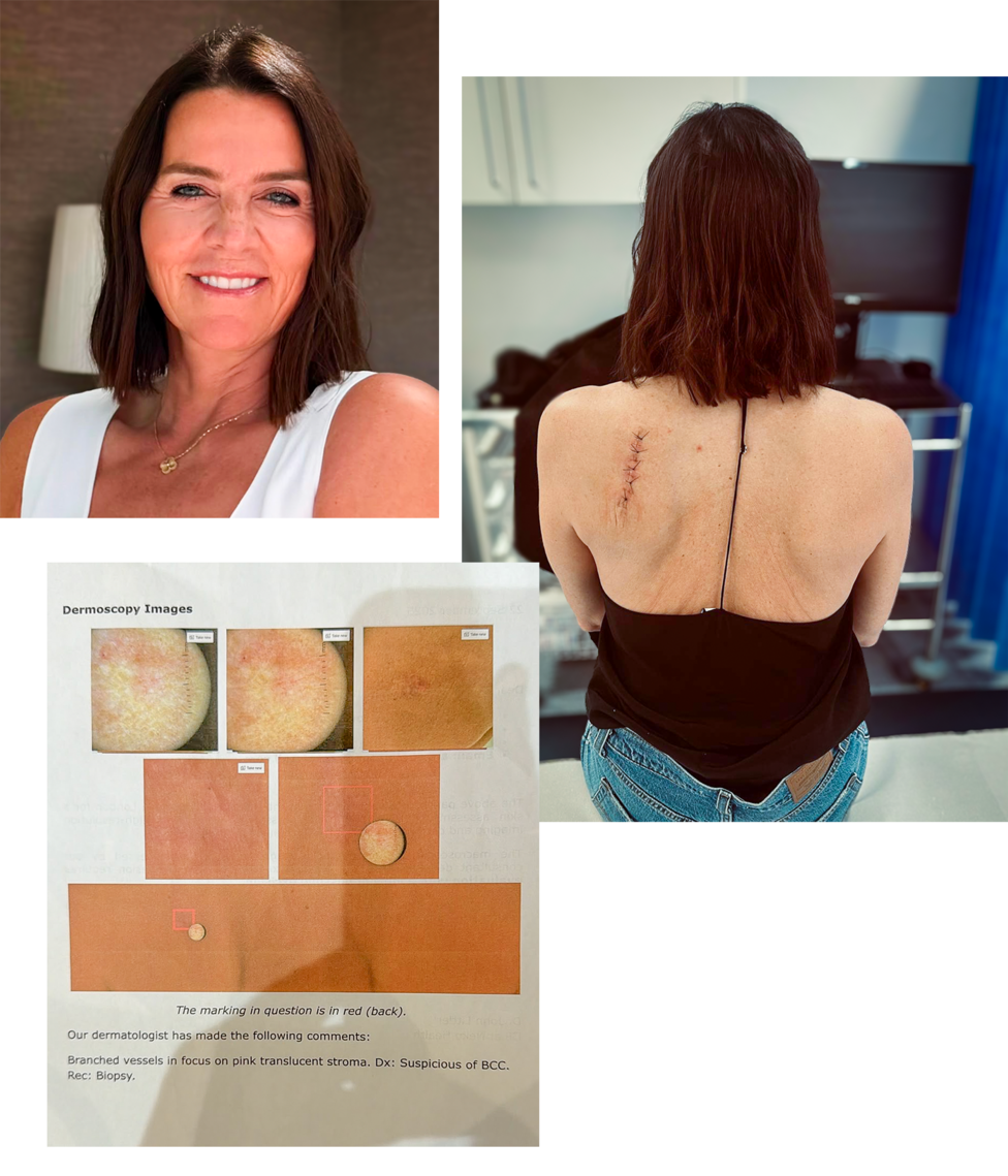 Annabel, her scans and picture of the post op scar on her back