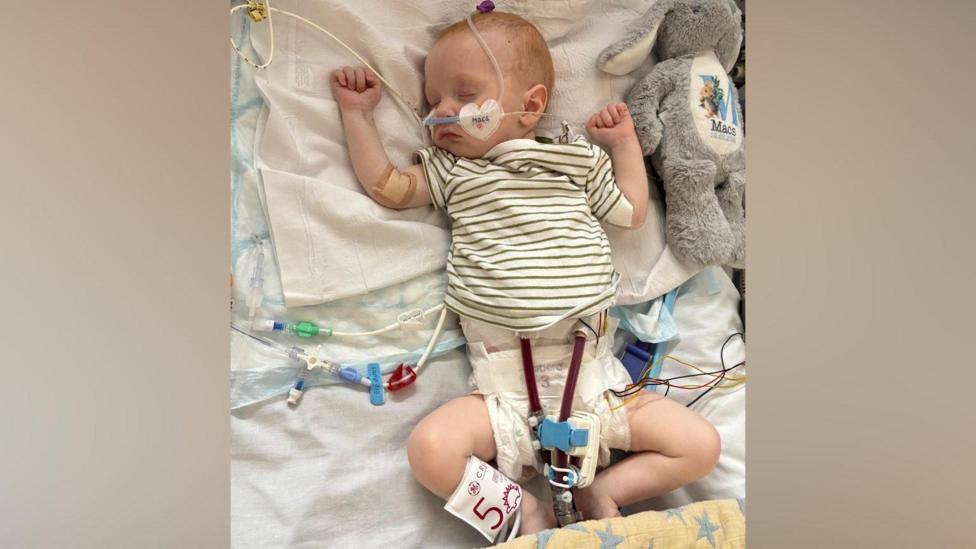 Macs Green is a small baby. He is lying in a hospital bed with tubes coming from his face and body.