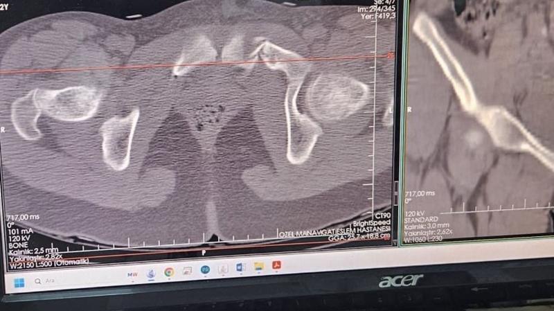 An x-ray which show fracture to pelvis