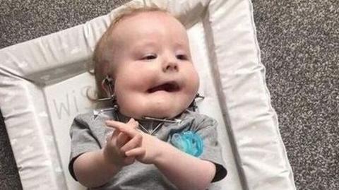 Noah Connell as a baby lying on a changing mat. He has blond hair and is wearing a grey T-shirt. He has a metal structure around his jaw. A blue dummy is lying on top of him.