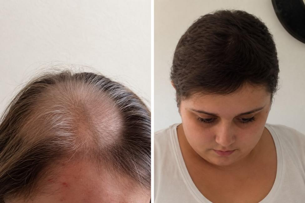 Two images of Becky Jones. In the left hand side you can see the effects of taking cancer drugs where her hair has thinned and greyed. In the right hand side she is looking down 