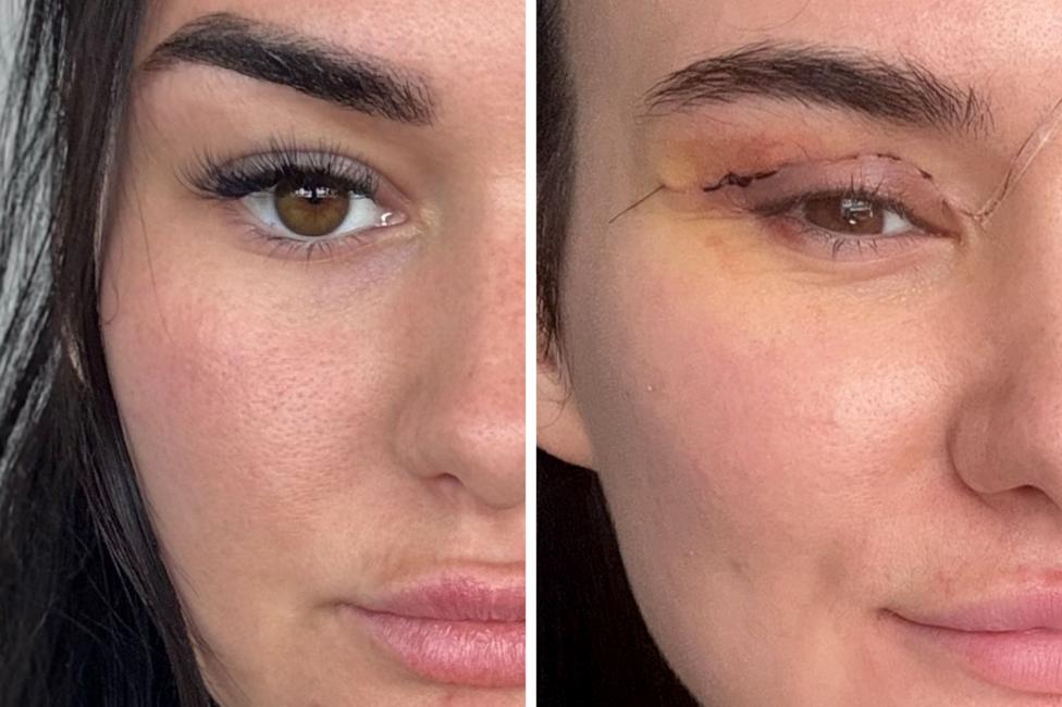 Side‑by‑side close‑ups of the same eye, showing a healthy eyelid on the left and a post‑surgical eyelid on the right with visible sutures and bruising.