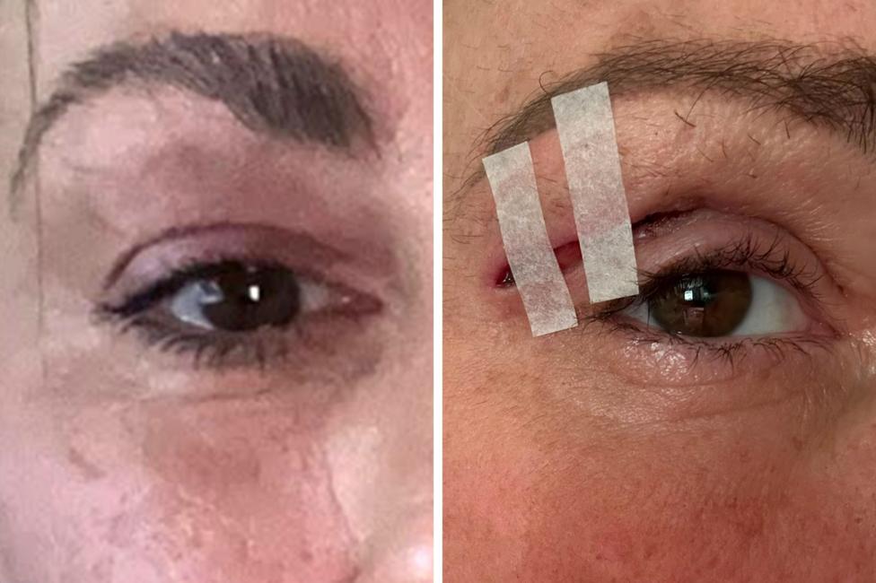 Side‑by‑side images showing the eye before treatment and the same eye afterwards, with medical tape applied over the healing upper eyelid.