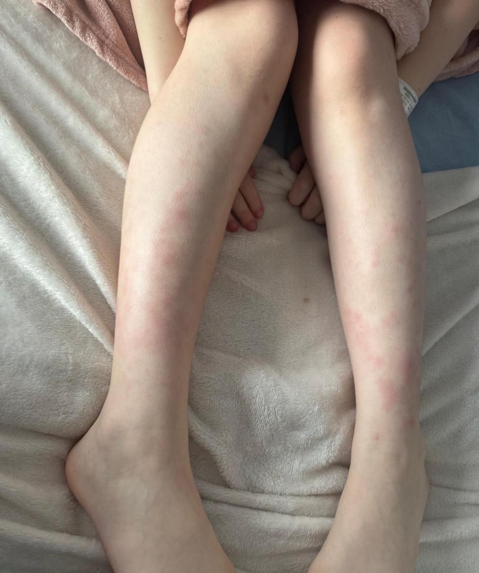 The legs of a young girl on top of a cream blanket showing raised red bruises across the shins.