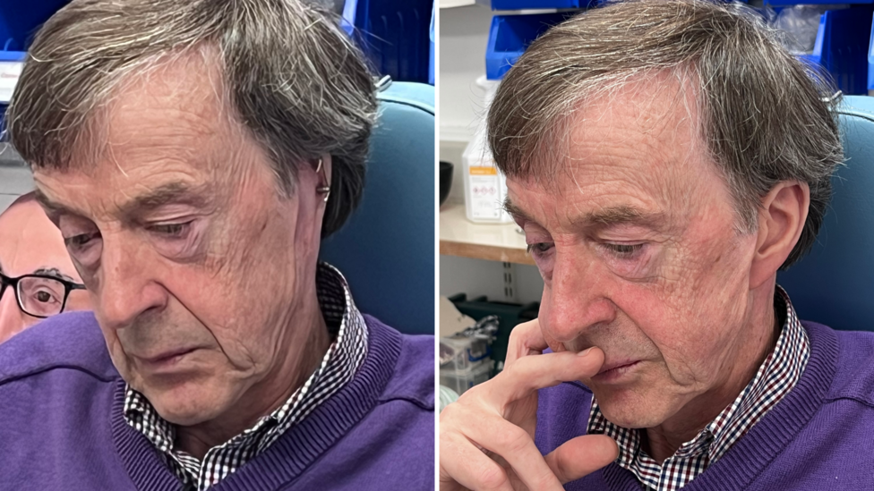 Two pictures of the same man, before and after having a prosthetic ear attached. He is an older man, with short, dark grey hair, wearing a check shirt and a purple jumper.