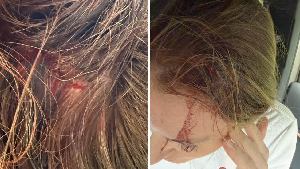 Two images of the same woman's head injury. Left, a close up of a cut on her head. The right image shows her bloody forehead.